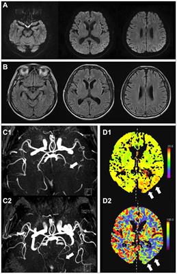 Case report: Neuronal intranuclear inclusion disease initially mimicking reversible cerebral vasoconstriction syndrome: serial neuroimaging findings during an 11-year follow-up